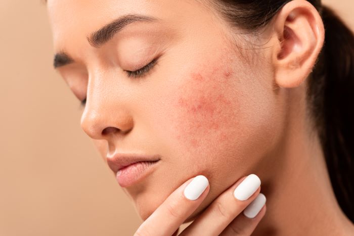 une jeune femme qui a des problèmes de peau © DepositPhotos