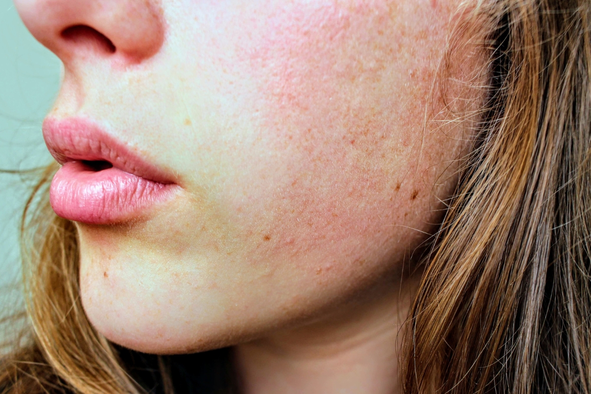 exemple d'une femme à la peau sèche