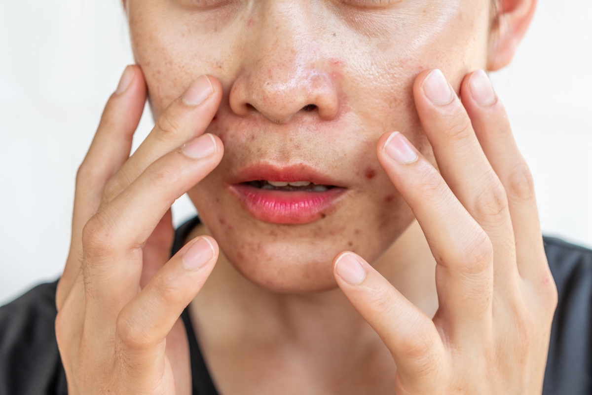 exemple d'une femme à la peau grasse