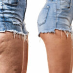 Quelles sont les causes de la cellulite ?