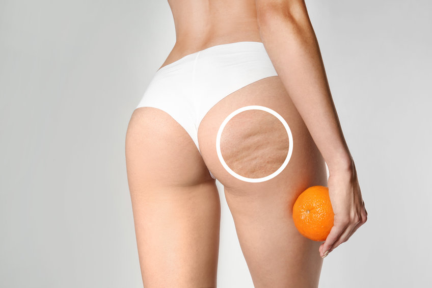 Un cercle ciblant une zone de cellulite sur la peau des fesses dune femme